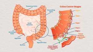 malignant tumors