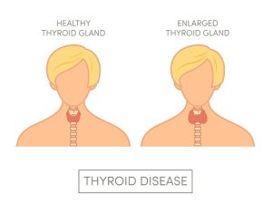 thyroid cancer