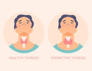 Symptoms of Hypothyroidism in Men